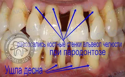 Пародонтоз 9 Фото Лечение В Домашних Условиях ЛюмиДент