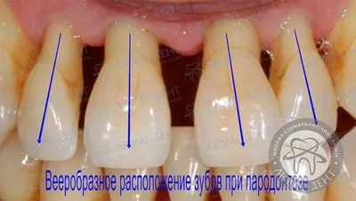 Протезирование зубов при пародонтозе и пародонтите в Минске - Новости и  статьи