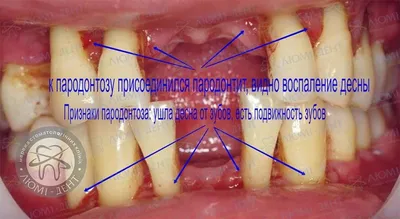 Пародонтоз 9 Фото Лечение В Домашних Условиях ЛюмиДент