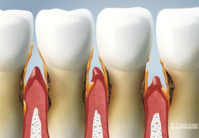 Современное лечение пародонтоза