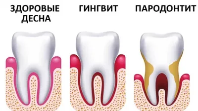 Стоматология Ориен-дента - Пародонтит и пародонтоз — слова похожи, а вот  заболевания разные. Объясняю разницу ниже, жмите ❤️ . Пародонт — это единая  система тканей, окружающих зуб. В нее входят дёсны, костная