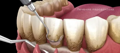 Пародонтоз: симптомы, причины, лечение, народное лечение – Стоматология в  Бирюлево