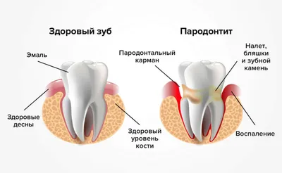 Отличия пародонтоза и пародонтита – симптомы, клиника, лечение