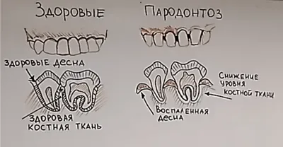 Пародонтоз: диагностика и качественное лечение в Харькове