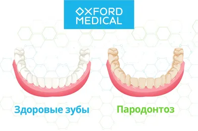 Пародонтоз виды и симптомы, лечение пародонтоза в Москве