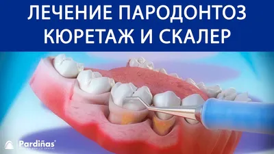 Пародонтит - лечение воспаленных тканей пародонта в Лёгкой стоматологии