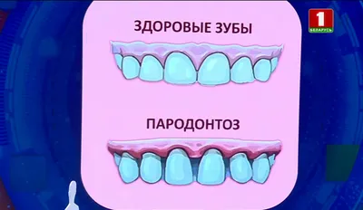 Имплантация зубов при пародонтозе | НК Клиник