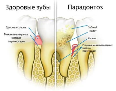 Лечение пародонтоза десен: цены в Москве | Cтоимость лечения пародонтоза в  стоматологии «Кавитрон» на Анохина и Вавилова