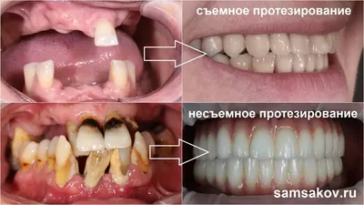 Пародонтоз: лечение у зубов и десен в домашних условиях