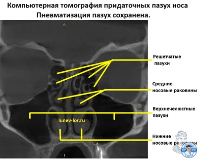 Расшифровка КТ пазух носа | Второе мнение