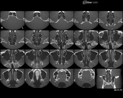 Анатомия полости носа и околоносовых пазух: иллюстрации с обозначением  анатомических структур | e-Anatomy