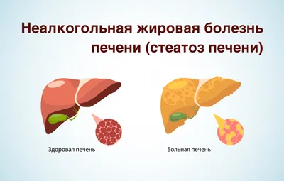 Как восстановить печень после алкоголя - список продуктов | Стайлер