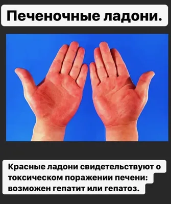 Ответы Mail.ru: Похоже на печеночные ладони?