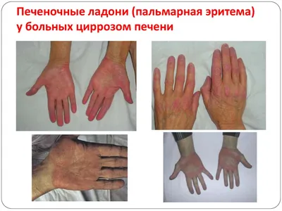 Оценка тяжести состояния пациентов с циррозом печени Выполнила: