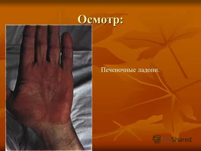 Calaméo - Стояновский Д.Н., Диагностика заболеваний по кожным рисункам  ладони