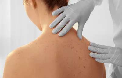 Пигментация кожи: что это, причины нарушения и способы лечения | РБК Стиль