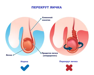 Перекрут яичка - причины появления, симптомы заболевания, диагностика и  способы лечения