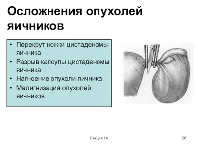 Эпидидимит - симптомы острой и хронической форм, стадии и признаки у мужчин  и женщин, причины появления, диагностика и лечение заболевания