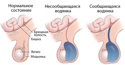 Лечение крипторхизма (неопущение яичка) в Израиле - IsraHospital