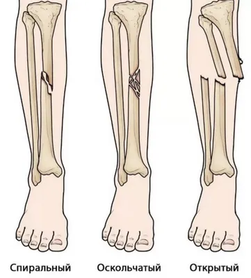 Лечение переломов длинных костей в Хабаровске - Медикъ