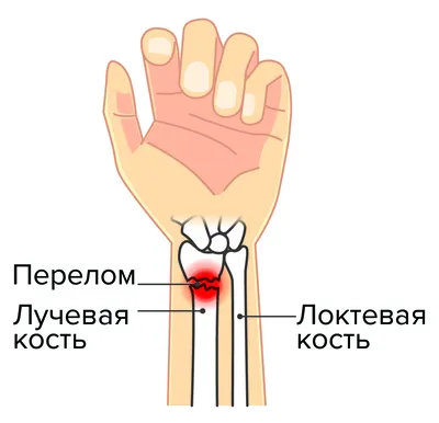 Переломы костей предплечья - Клиника 29