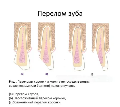 Перелом дистального отдела лучевой кости - KinesioPro