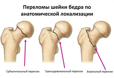 Перелом шейки бедра - Центр травматологии и ортопедии