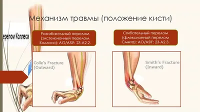 Перелом руки и армия | Помощь призывникам | Призывник.Info | Дзен