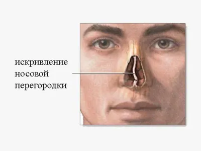 Перелом костей носа. Диагностика и симптомы. Клиника врача ЛОРа Дмитрия  Субботы в Москве