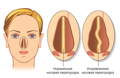 Осложнения после ринопластики | Александр Маркушин пластический хирург