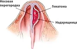 Ринопластика - коррекция формы носа во Владивостоке - цены