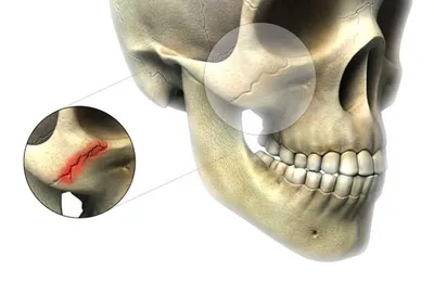Лечение переломов скуловой кости