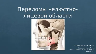 Перелом скуловой кости со смещением - Хирургическая стоматология -  Стоматология для всех