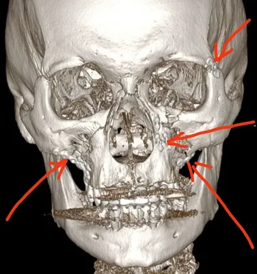 У Кади подозрение на перелом лицевой кости | ПЛЕЙМЕЙКЕР