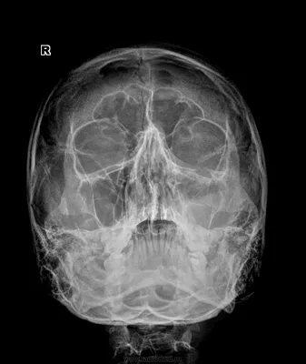 Односторонний изолированный перелом крыловидного отростка клиновидной кости:  клинический случай - Balzano - Digital Diagnostics