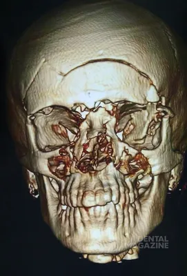 Клинический случай тяжелой краниофациальной травмы - DENTALMAGAZINE.RU