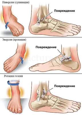 Переломы лодыжек - лечение в клинике Линько.