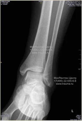Современные методы лечения переломов как фактор скорейшей активизации  больных: часть 1 – переломы лодыжек -Наши новости