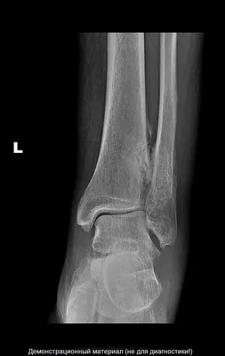 Современные методы лечения переломов как фактор скорейшей активизации  больных: часть 1 – переломы лодыжек -Наши новости