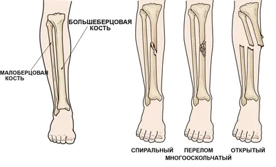 Перелом наружной лодыжки рисунок - 88 фото