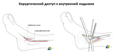 Удаление позиционного винта при переломе лодыжки - «Можно ли удалить  позиционный винт под местным наркозом и больно ли это?» | отзывы