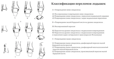 перелом лодыжки без смещения | Портал радиологов