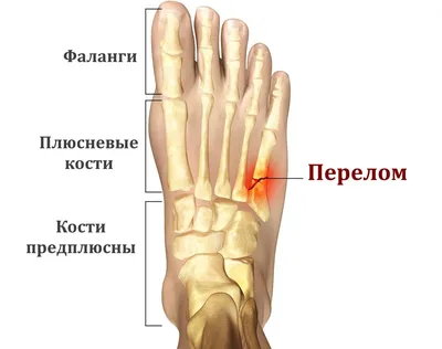 Перелом пяточной кости, лечение и реабилитация в Москве