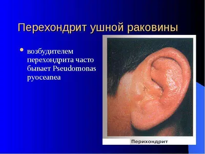 Острое воспаление наружного и среднего уха