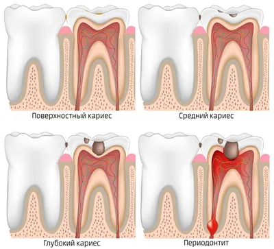 Гранулематозный периодонтит | Симптомы, лечение, профилактика | Клиника  семейной стоматологии Дока-Дент