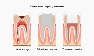 Периодонтит - острый и апикальный: симптомы, причины возникновения,  диагностика и лечение хронических форм