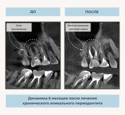 🦷Периодонтит зуба: цена лечения в Москве