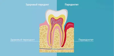 Лечение периодонтита в СПб - цена в стоматологии \"Чистое дыхание\"