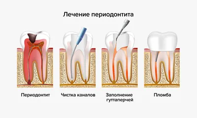 Периодонтит Зуба Лечение Киев На Рентгене ЛюмиДент