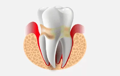 Периодонтит и его лечение - стоматология Мастер клиник в г.Бресте